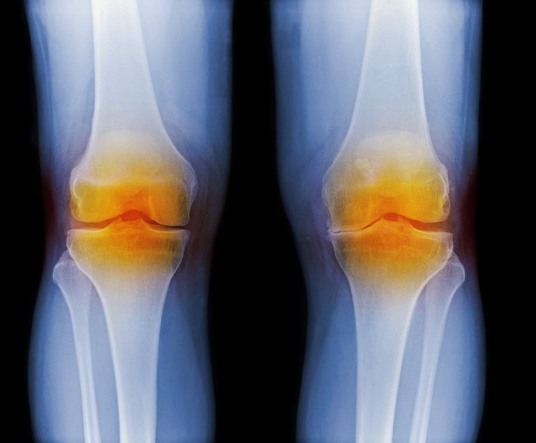 progressieve gewrichtsschade, Reumatoïde artritis, zijn voor, aangetaste gewrichten, bereiken remissie