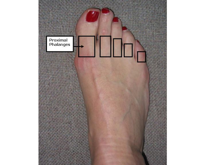 proximale falanx, grote teen, botten voet, deze botten, meestal veroorzaakt