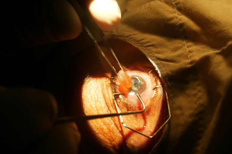 Cataract Surgery, geen laser, groeit meestal, groeit meestal langzaam