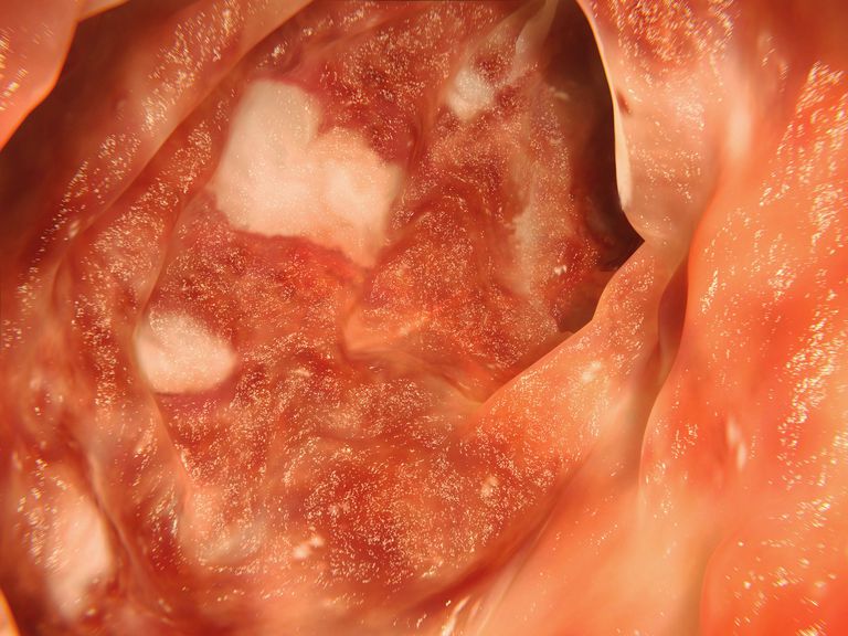 ziekte Crohn, colitis ulcerosa, dikke darm, nodig zijn, door colitis