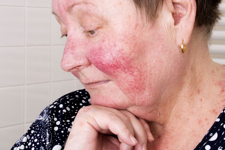 volwassen acne, worden gebruikt, andere aandoeningen, behandelingen kunnen