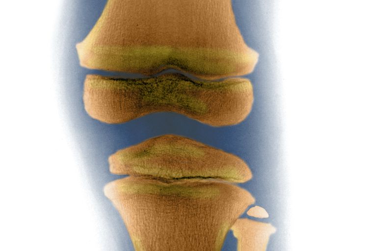 De betekenis van subchondraal bot bij artrose