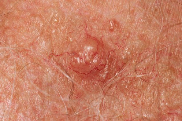 huid verschijnen, meest voorkomende, wordt marge, abnormale gezwellen