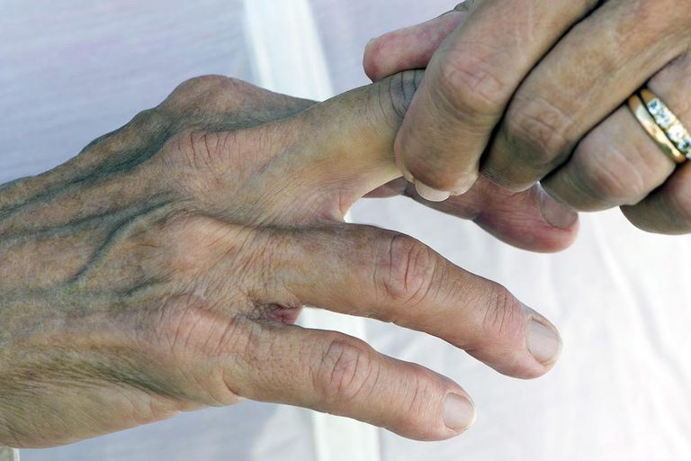 vastgelopen vinger, genezende vinger, chiropractor osteopaat, fractuur dislocatie, lichte verwonding