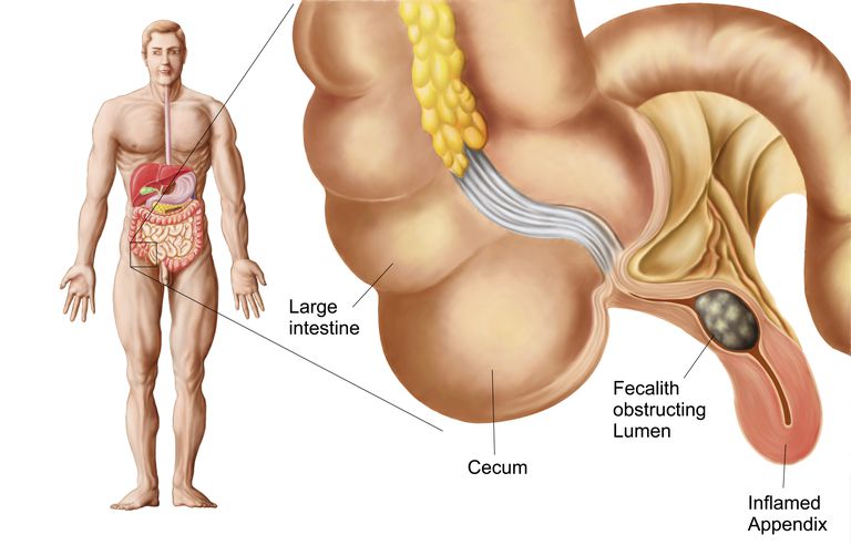 colitis ulcerosa, ziekte Crohn, verwijderen appendix, ontwikkelen colitis