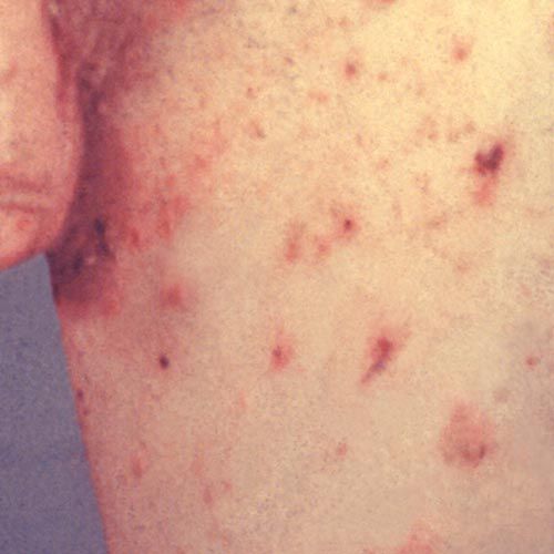 Bacteriële infecties, schurft hebben, arts raadplegen, ernstige jeuk, huid ziet