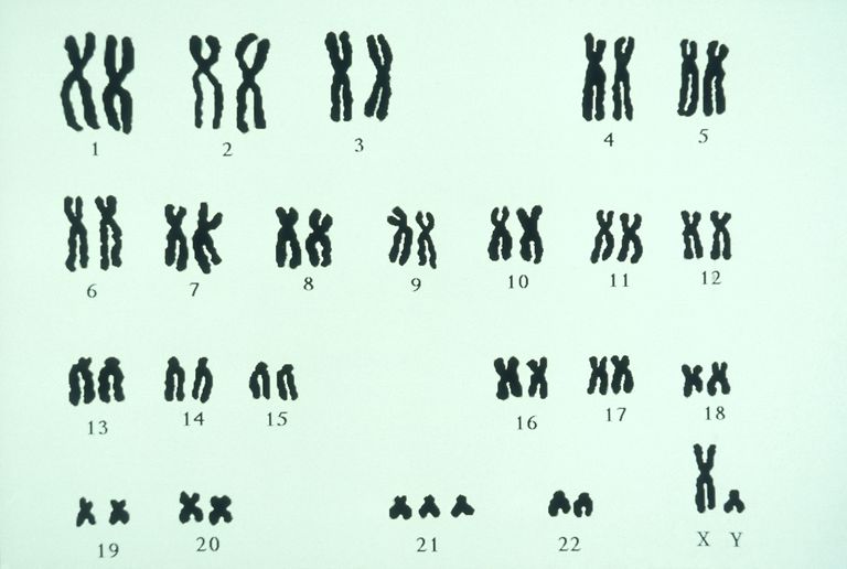 fysieke kenmerken, 21ste paar, 21ste paar chromosomen, chromosoom verbonden, drie soorten, extra chromosoom