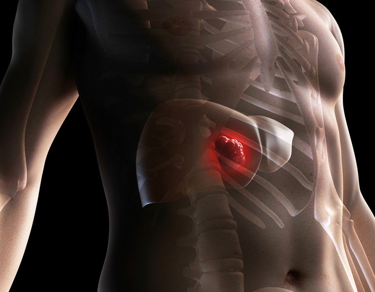 tumoren lever, wordt gebruikt, graad kanker, heeft verspreid, kunnen worden, levermetastasen vertonen