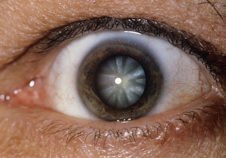 Cataract zich, type cataract, basis locatie, blootstelling bepaalde