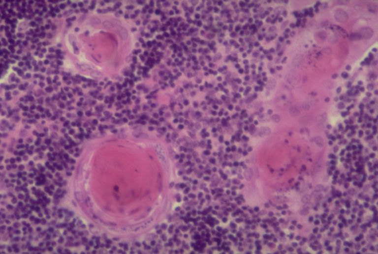 myasthenia gravis, witte bloedcellen, ongeveer gram, thymus waar