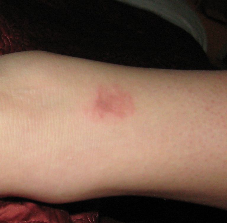 dezelfde manier, Frostbite beschadigt, beschadigt huid, beschadigt huid dezelfde, bevriezing veroorzaakt, bevriezing veroorzaakt verkleuring