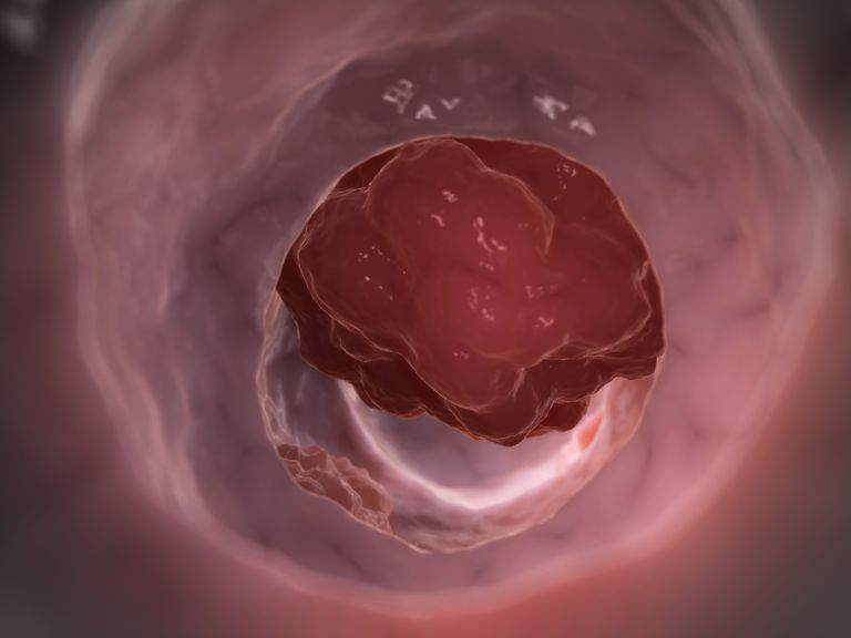 april 2015, York McGraw-Hill, bloed ontlasting, bloederige ontlasting, colorectale kanker, anale fissuren