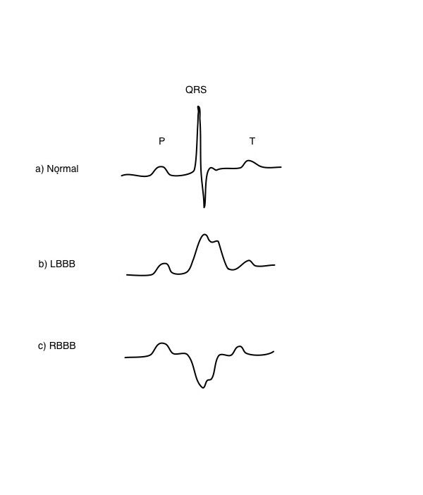 elektrische impuls, beide ventrikels, elektrische signaal, rechter linker