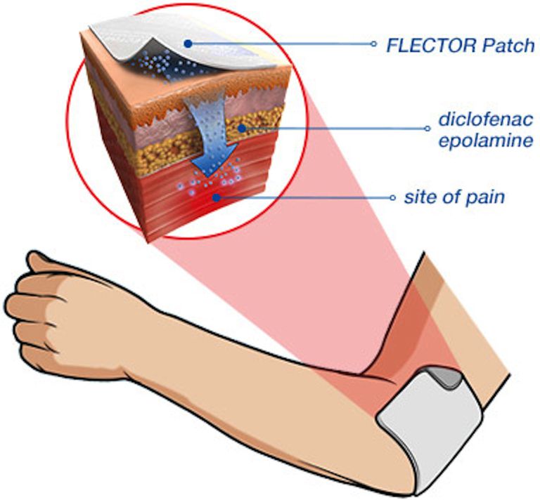 alternatief voor, artrose knie, door patiënten, Flector-pleister niet