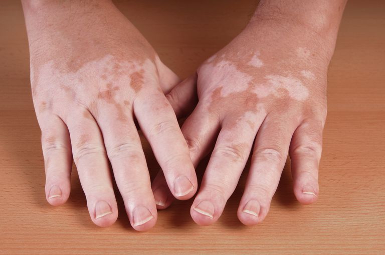 voor vitiligo, auto-immuunziekte schildklier, witte vlekken, aangetaste gebieden
