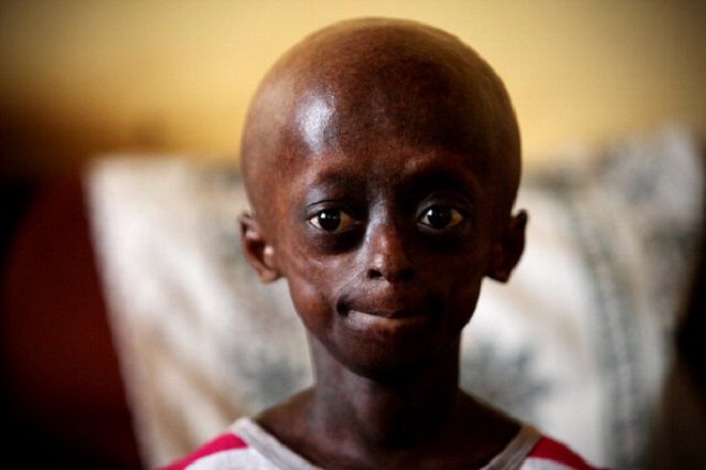 Hutchinson-Gilford progeria, jaren ouder, niet ongebruikelijk, ongeveer miljoen, snelle veroudering, syndroom Werner