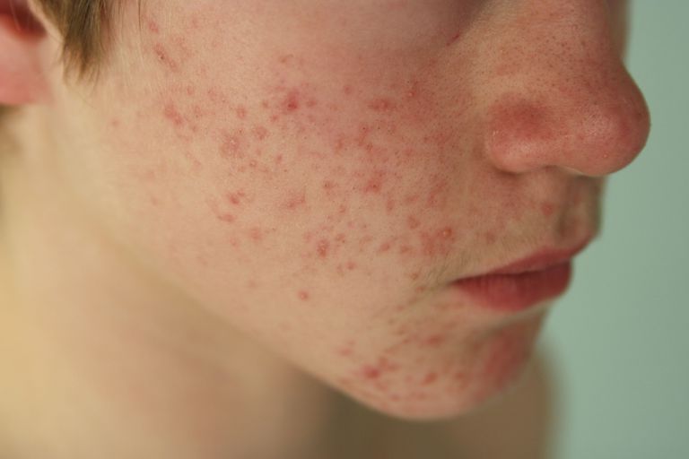 volwassen acne, Acne vulgaris, acne rosacea, acne rosacea heeft, acne zijn