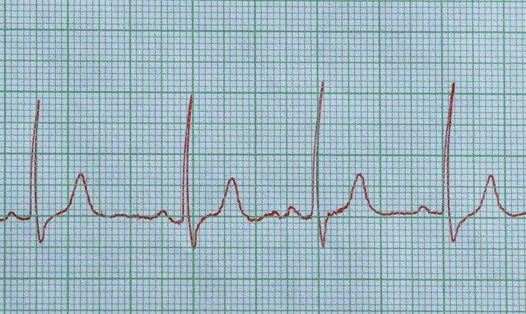 wordt genoemd, elektrische impuls, normale hartritme, onderliggende oorzaak, sinusknoop wordt, sinustachycardie normaal