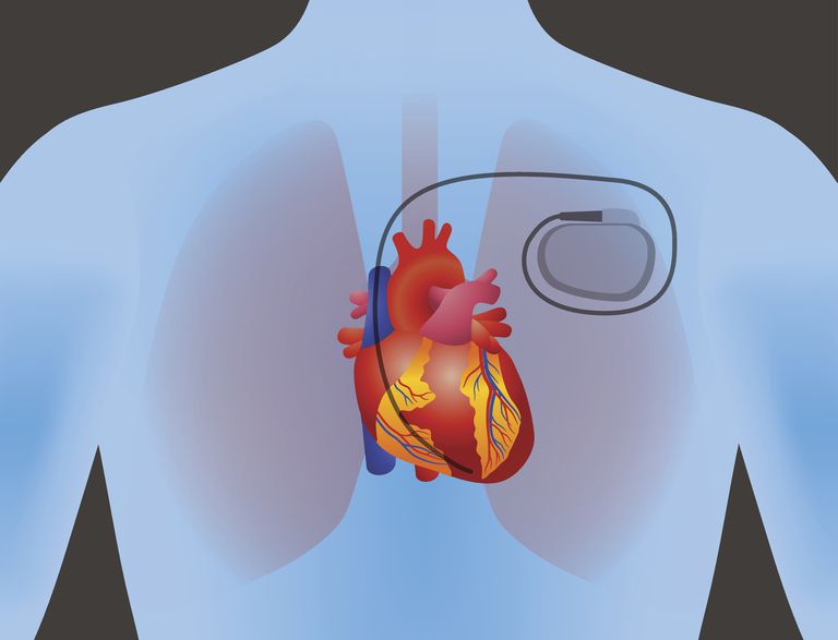 pacemaker nodig, derde graad, distaal hartblok, elektrische impulsen