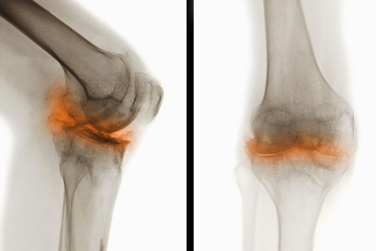 bewijs artrose, diagnosticeren artrose, gebruikt voor, gezamenlijke ruimte, röntgenonderzoek osteoartritis, subchondrale sclerose